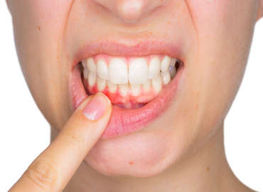 Hatice_Samur_Akn_Di_Eti_Periodontoloji Hatice_Samur_Akn_Di_Eti_Periodontoloji