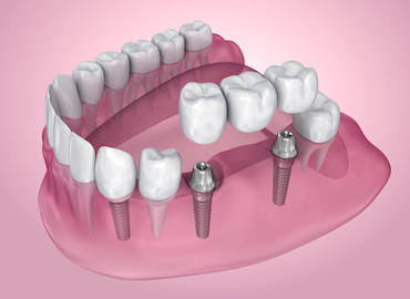 implant implant